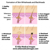 Skin blackheads illustration