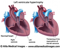Left ventricular hypertrophy labeled diagram