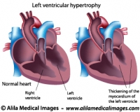Left ventricular hypertrophy labeled diagram