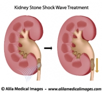 Treatment of kidney stones, medical drawing.