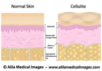 Cellulite versus smooth skin, labeled diagram.