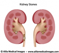 Kidney stones, medical drawing.