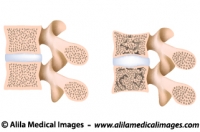 Lumbar spine osteoporosis, medical drawing.