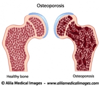 Osteoporosis, medical illustration.