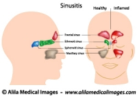 Sinusitis, labeled diagram.