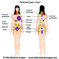 Referred pain chart, labeled diagram.