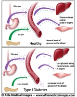 Type 1 diabetes, labeled diagram.