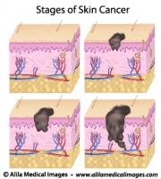 Skin cancer staging, medical drawing.