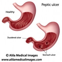 Peptic ulcers, labeled diagram.