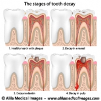 Plaque and tooth decay, medical drawing.
