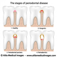 Periodontal Disease, labeled diagram.