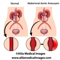 Abdominal aortic aneurysm diagram