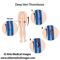 Deep vein thrombosis diagram