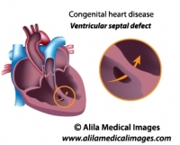 Ventricular septal heart defect diagram.