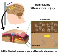 Brain trauma with axon shear, labeled diagram.