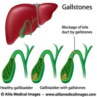 Gallstones, labeled diagram.