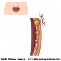 Urinary bladder cancer stages, medical drawing.