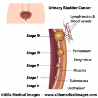 Urinary bladder cancer stages, labeled. 