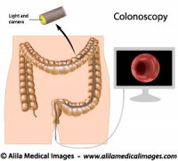 Colonoscopy procedure, labeled diagram.