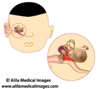 Middle ear infection, unlabeled diagram.