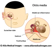 Middle ear infection, labeled diagram.