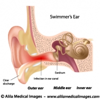 Outer ear infection, labeled diagram.