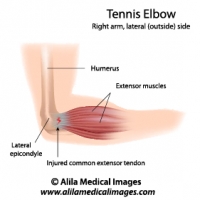 Tennis elbow sport injury, labeled diagram.