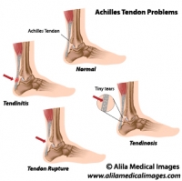 Achilles tendon problems, labeled diagrams.