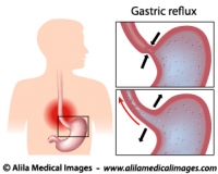 Heartburn, stomach acid reflux, , medical illustration.