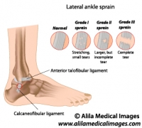 Ankle sprain grading, labeled diagram.