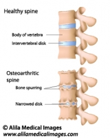Osteoarthritis of the spine, labeled drawing.