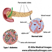 Diabetes type 1, labeled diagram.