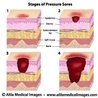 Stages of pressure sores, labeled diagram.