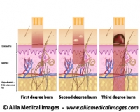 Degrees of skin burns, medical illustration.