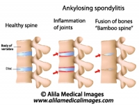 Ankylosing spondylitis of the spine, labeled diagram.