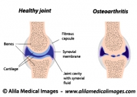 Synovial joint normal and arthritis, labeled diagram.