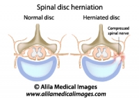 Spinal disc herniation, labeled diagram.