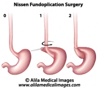 Nissen Fundoplication Surgery, medical drawing.