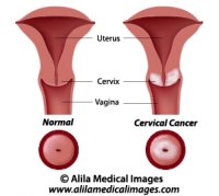 Cervical cancer, labeled diagram.