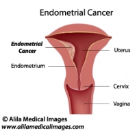 Uterine cancer, labeled diagram.