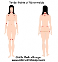 Tender points of fibromyalgia, medical drawing.