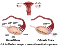 Polycystic and normal ovary, labeled diagram.