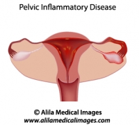 Pelvic inflammatory disease (PID) 