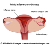 Pelvic inflammatory disease (PID) diagram