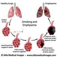 Smoking and Emphysema, labeled diagram.