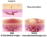 Contact dermatitis, medical drawing.