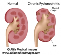 Chronic pyelonephritis, labeled diagram.