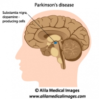 Parkinson's disease, labeled diagram.