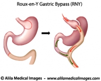 Roux-en-Y Gastric Bypass, medical drawing.