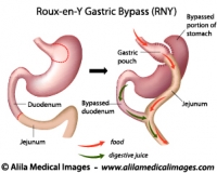 Roux-en-Y Gastric Bypass surgery, labeled diagram.